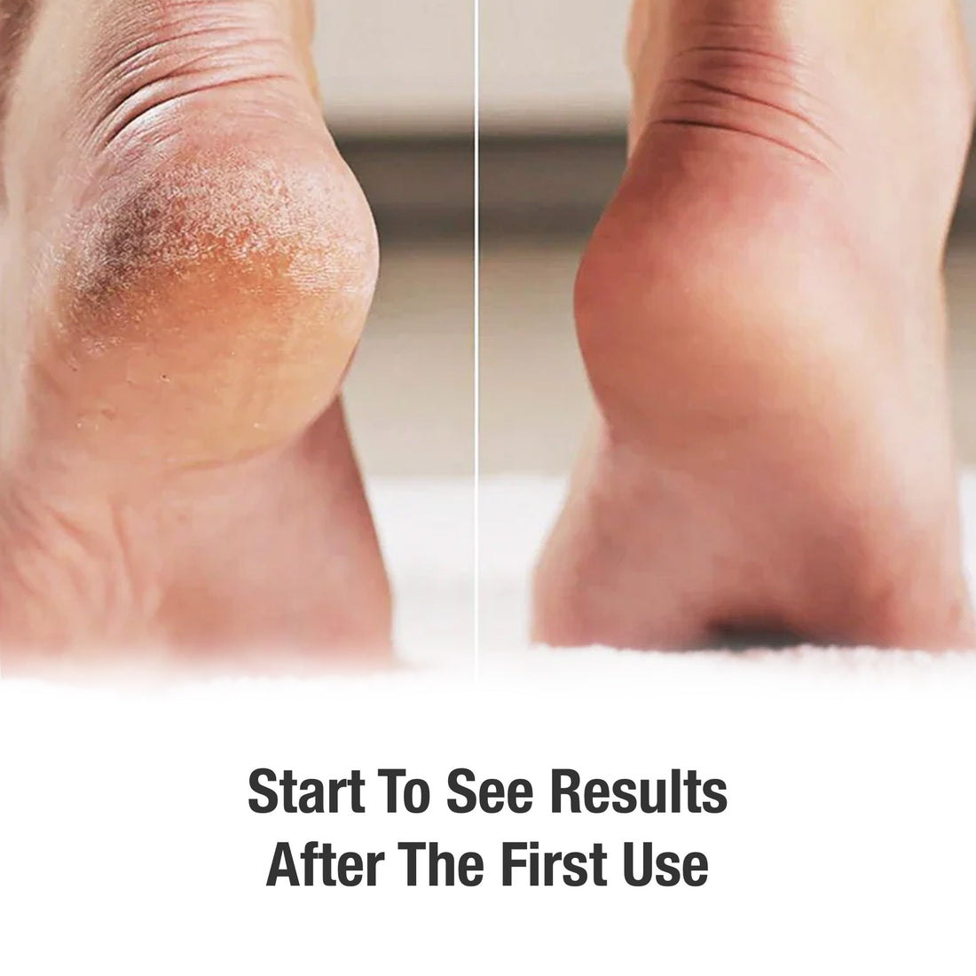 Revitalize Your Feet with a 42% Urea Cream Foot Cream: Dead Skin Removal & Crack Heel Moisturizer